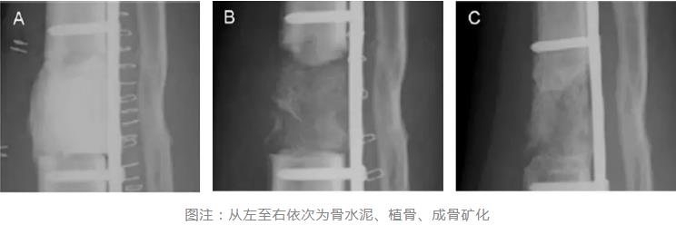 Masquelet影像学过程
