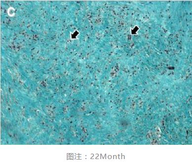 Masquelet技术22m组织学