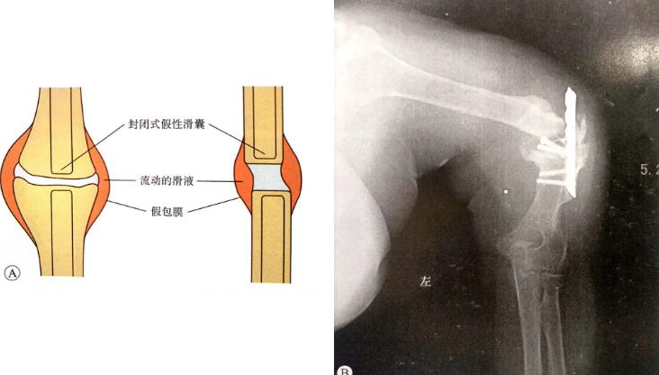 假关节性骨不连