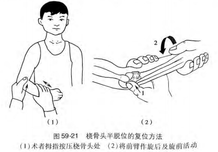 桡骨头半脱位复位方法