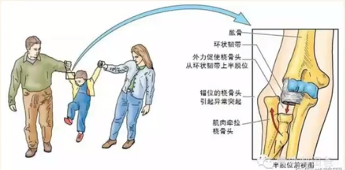 桡骨小头半脱位大手拉小手示意图