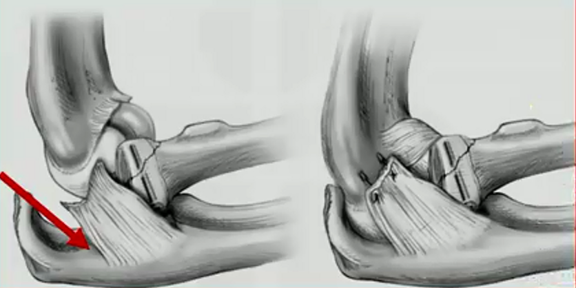 桡骨小头半脱位时候可能会合并桡骨小头骨折