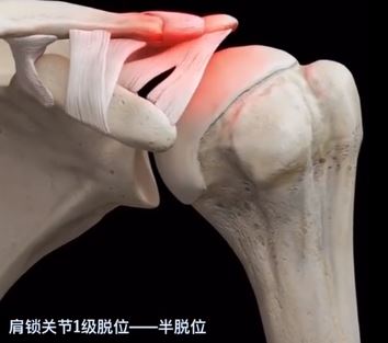 肩锁关节1级脱位