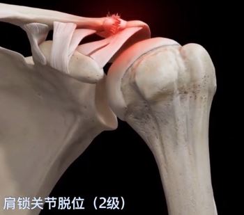 肩锁关节2级脱位