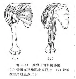 肱骨干骨折的移位